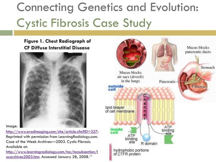 Case study cystic fibrosis answers